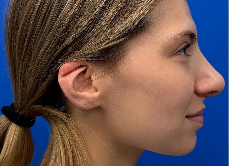 Rhinoplasty Before & After Gallery - Patient 121727056 - Image 10