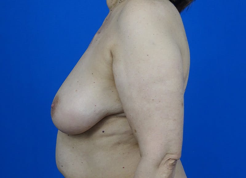 Flap Reconstruction Gallery Before & After Gallery - Patient 593293 - Image 1