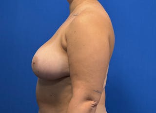 Breast Reduction Before & After Gallery - Patient 442749 - Image 2