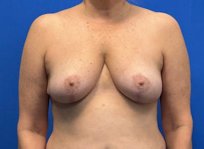 Breast Reduction Before & After Gallery - Patient 121727721 - Image 6