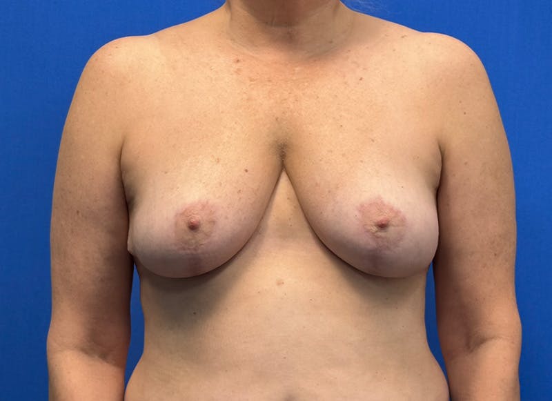 Breast Reduction Before & After Gallery - Patient 121727721 - Image 6