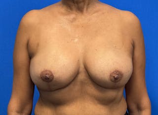 Flap Reconstruction Gallery Before & After Gallery - Patient 112338049 - Image 6