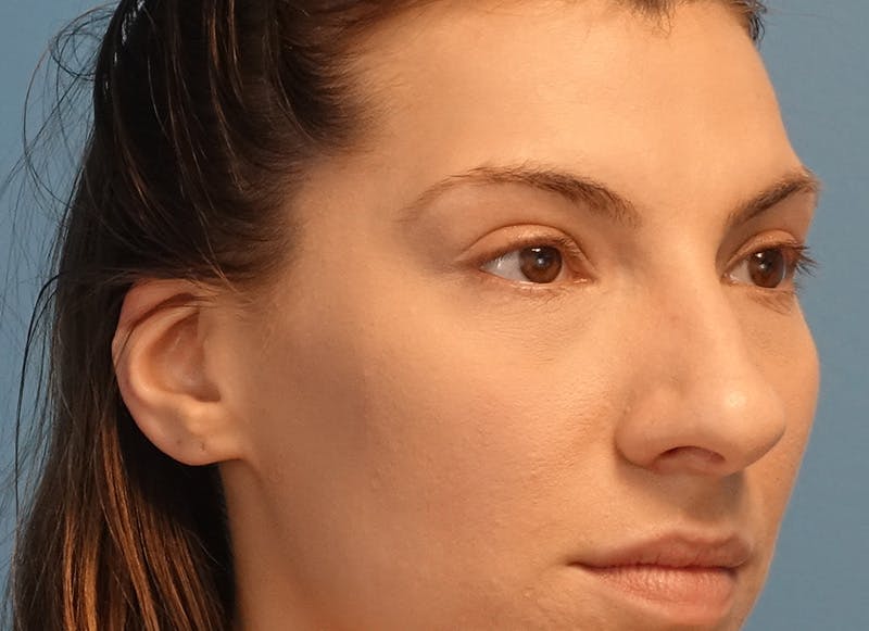 Rhinoplasty Before & After Gallery - Patient 121727056 - Image 7
