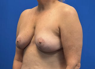 Breast Reduction Before & After Gallery - Patient 121727721 - Image 4