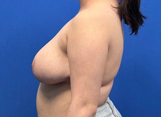 Breast Reduction Before & After Gallery - Patient 102661 - Image 2