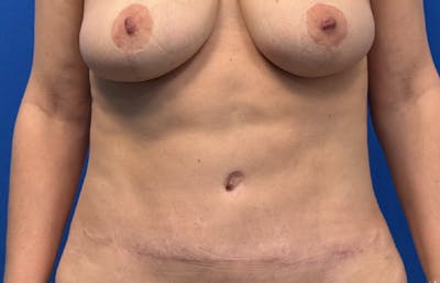Abdominoplasty Before & After Gallery - Patient 445970 - Image 6