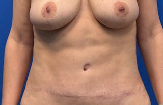 Abdominoplasty Before & After Gallery - Patient 445970 - Image 6