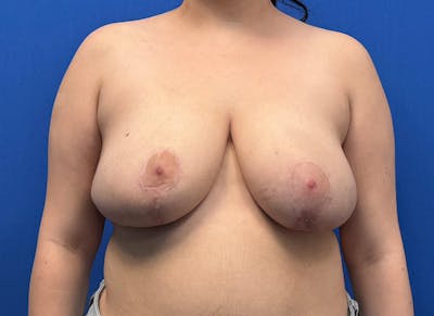 Breast Reduction Before & After Gallery - Patient 102661 - Image 6