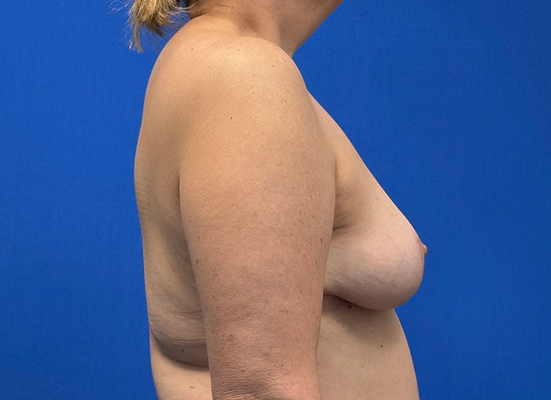 Breast Reduction Before & After Gallery - Patient 121727721 - Image 10