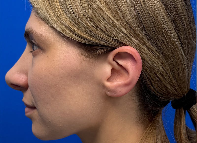 Rhinoplasty Before & After Gallery - Patient 121727056 - Image 2