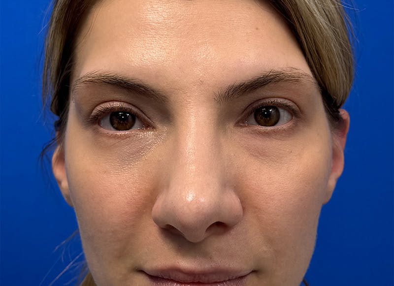 Rhinoplasty Before & After Gallery - Patient 121727056 - Image 6