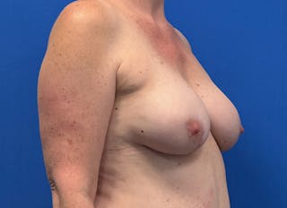 Flap Reconstruction Gallery Before & After Gallery - Patient 415135 - Image 8