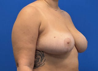 Breast Reduction Before & After Gallery - Patient 442749 - Image 8