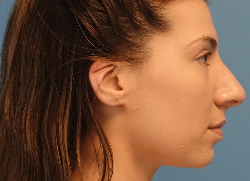 Rhinoplasty Before & After Gallery - Patient 121727056 - Image 9