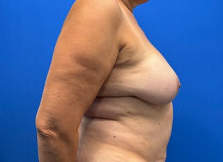 Flap Reconstruction Gallery Before & After Gallery - Patient 593293 - Image 10