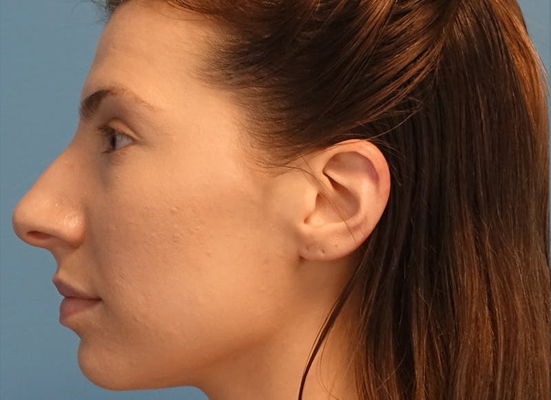 Rhinoplasty Before & After Gallery - Patient 121727056 - Image 1