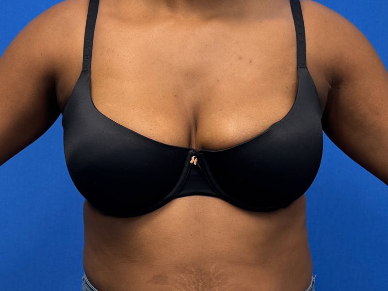Axillary Breast Removal Before & After Gallery - Patient 362736 - Image 2