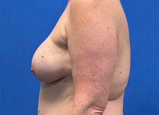 Flap Reconstruction Gallery Before & After Gallery - Patient 415135 - Image 2