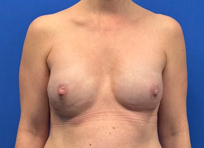 Implant Reconstruction Gallery Before & After Gallery - Patient 112337922 - Image 6