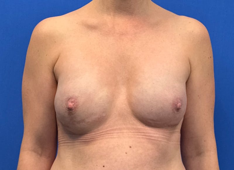 Implant Reconstruction Gallery Before & After Gallery - Patient 112337922 - Image 6
