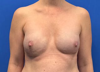 Implant Reconstruction Gallery Before & After Gallery - Patient 112337922 - Image 6