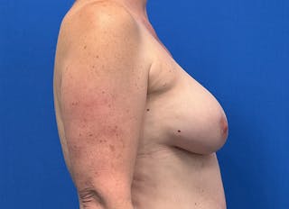 Flap Reconstruction Gallery Before & After Gallery - Patient 415135 - Image 10