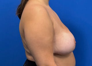 Breast Reduction Before & After Gallery - Patient 330841 - Image 10