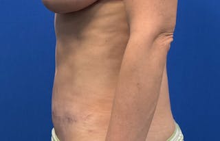 Abdominoplasty Before & After Gallery - Patient 445970 - Image 2