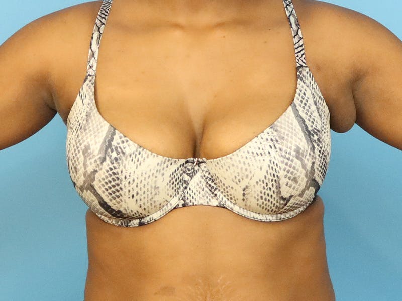 Axillary Breast Removal Before & After Gallery - Patient 362736 - Image 1