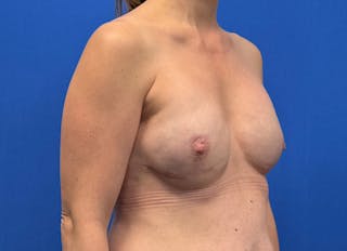 Implant Reconstruction Gallery Before & After Gallery - Patient 112337922 - Image 8