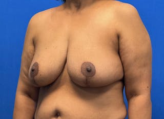 Breast Reduction Before & After Gallery - Patient 352522 - Image 4