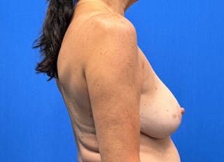 Breast Reduction Before & After Gallery - Patient 623681 - Image 10