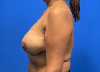 Flap Reconstruction Gallery Before & After Gallery - Patient 112338049 - Image 2