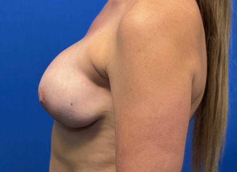 Hybrid Reconstruction Gallery Before & After Gallery - Patient 112338059 - Image 2