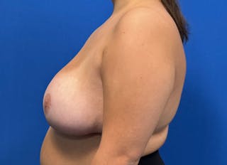 Breast Reduction Before & After Gallery - Patient 330841 - Image 2
