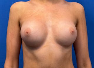 Augmentation Before & After Gallery - Patient 231435 - Image 6