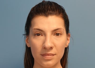 Rhinoplasty Before & After Gallery - Patient 121727056 - Image 1
