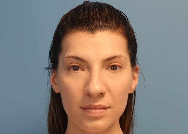 Rhinoplasty Before & After Gallery - Patient 121727056 - Image 1