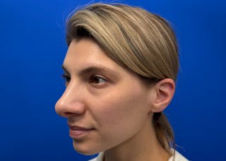 Rhinoplasty Before & After Gallery - Patient 121727056 - Image 8