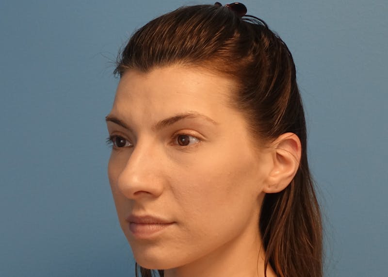 Rhinoplasty Before & After Gallery - Patient 121727056 - Image 7
