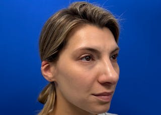 Rhinoplasty Before & After Gallery - Patient 121727056 - Image 4