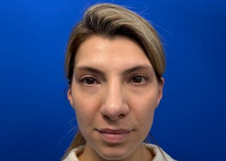 Rhinoplasty Before & After Gallery - Patient 121727056 - Image 2