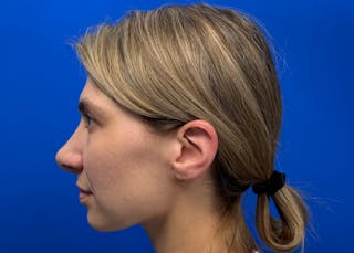Rhinoplasty Before & After Gallery - Patient 121727056 - Image 10