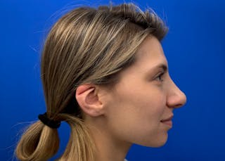 Rhinoplasty Before & After Gallery - Patient 121727056 - Image 6