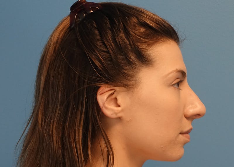 Rhinoplasty Before & After Gallery - Patient 121727056 - Image 5