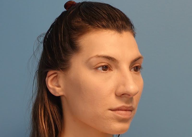 Rhinoplasty Before & After Gallery - Patient 121727056 - Image 3