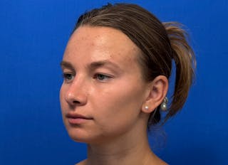 Rhinoplasty Before & After Gallery - Patient 244094 - Image 4