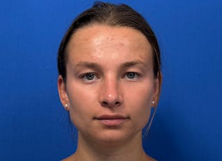 Rhinoplasty Before & After Gallery - Patient 244094 - Image 6