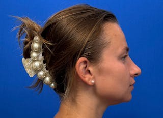 Rhinoplasty Before & After Gallery - Patient 244094 - Image 10