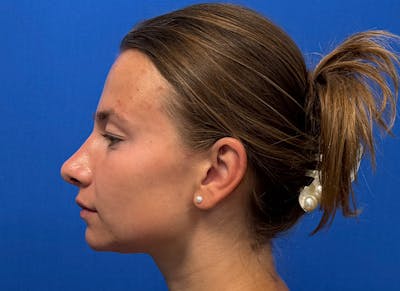 Rhinoplasty Before & After Gallery - Patient 244094 - Image 2